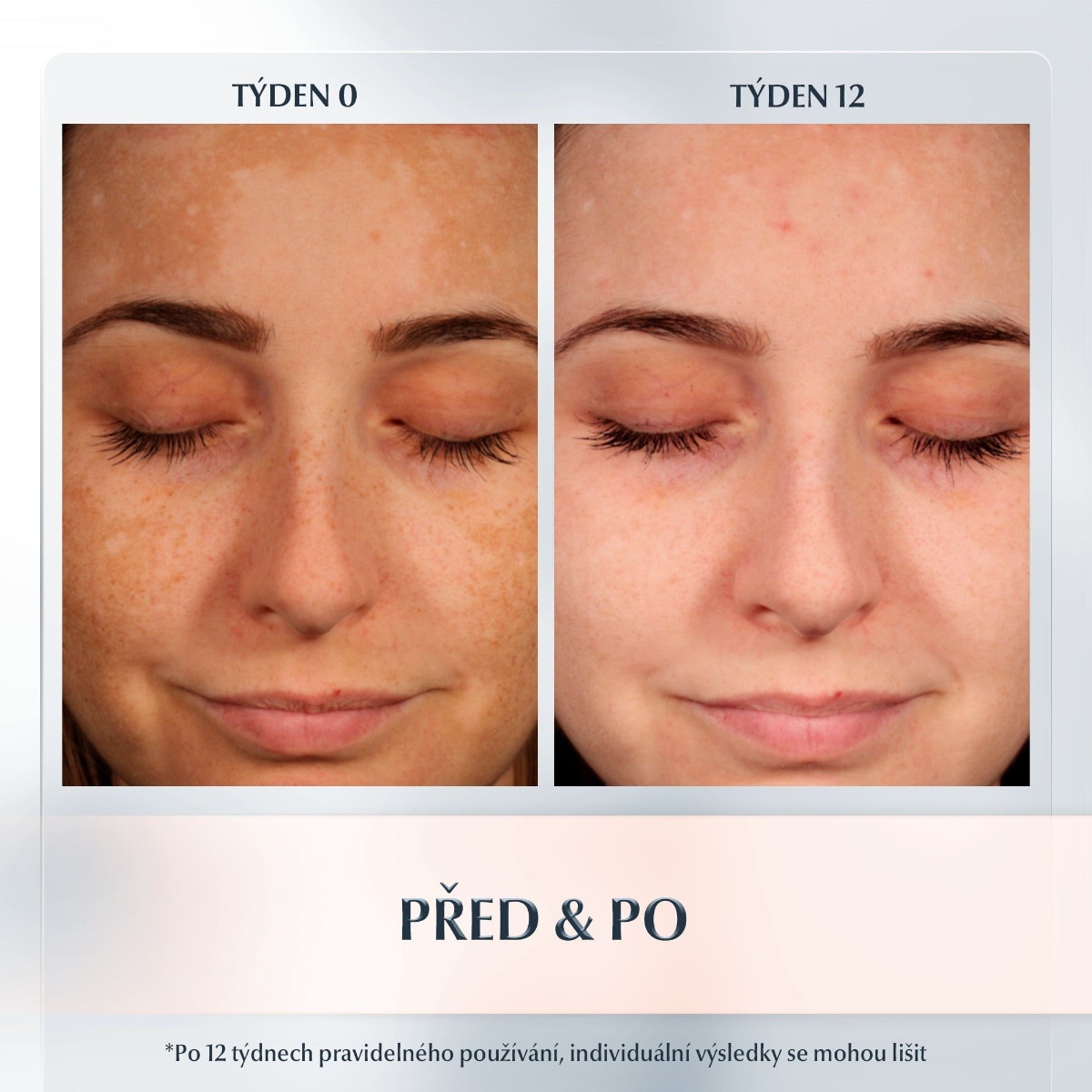 Eucerin AntiPigment lokální korektor 5 ml - Obrázek 5